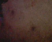 Black spots - Black spots on the face due to the pimples and the acnes. Black spots - Black spots on the face due to the pimples and the acnes.