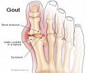 gout - this is from www.vibharam.com
