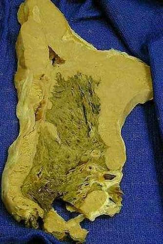 cancer - lung cancer