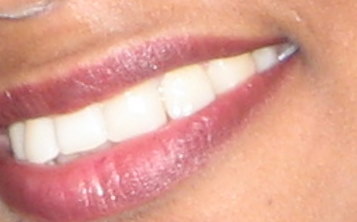 upper lip hair. - Image shows hair on the upper lip.