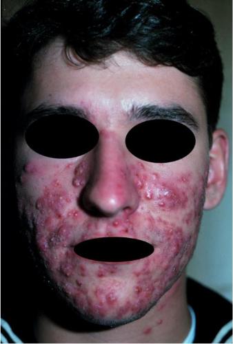 acne - terrible acne