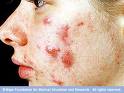 acne - go to hell acne
