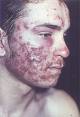 bad acne - dangerous acne