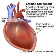 Pericarditis (Pericardium) - Photo showing what the pericardium is and how it can be affected around the heart.