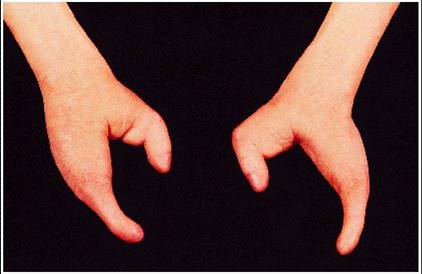 Lobster claw-like hands - This is the typical characteristics of people who suffer from ectrodactyly.