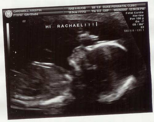 My ultrasound - 18 week ultrasound of our little girl, waving to her big sister.