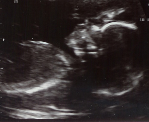 My ultrasound - 18 week ultrasound of our little girl, waving for the camera!