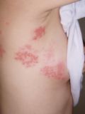 shingles - or herpes zoster
