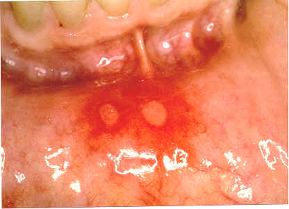 Mouth ulcers - How on earth do you get rid of them!