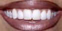 teeth - save your teeth, refrain from drinking sodas