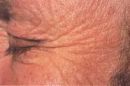 wrinkled skin of old age - Worse from the sun?