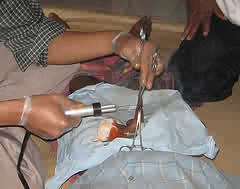 circumcision - performing a circumcision