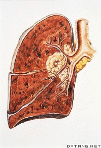 lung cancer -  Its a terrible disease.
