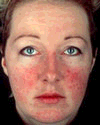 Rosacea - picture of a woman who has symptoms of the skin disorder rosacea