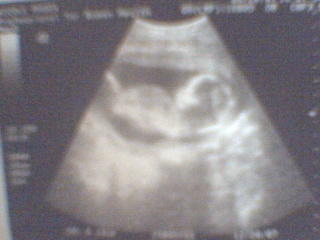 15 Weeks - Our second ultrasound picture!! Here she is 15 weeks and very bouncy,LOL!!