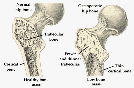 Osteoporosis - Pictures of 2 bones, one healthy and one with osteoporosis
