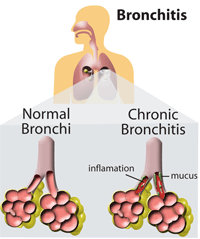 Bronchitis - picture of a normal bronchi and a picture of one with chronic bronchitis