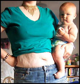 belly after baby - womans belly after baby