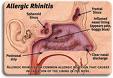 allergic rhinitis - seasonal or allergy in perfumes, dusts etc