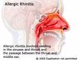 allergic rhinitis - allergy due to season or perfumes atc