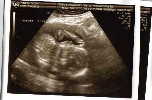 my ultrasound - my ultrasound at 5 months! my ultrasound - my ultrasound at 5 months!