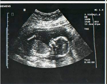pregnancy ultrasound - A ultrasound picture at 17 weeks.