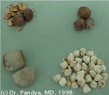 Gallstone_Gall Blader - What are GALLSTONES?  Some people form different size stones in the gallbladder. There may be a single stone or as many as 100 or more. Some stones are made of cholesterol, calcium, a blood pigment, or complex mixed stones with combination of above.  What is gallbladder and what is its function in the body?  Gallbladder is a pear shaped and sized bile bag, that is part of the biliary tree. It is connected to the bile tube coming from the liver. This bile tube is called common bile duct that joins with a tube coming from an organ called pancreas and opens in to a part of intestine called duodenum. The normal function of the gallbladder is to store the bile produced by the liver until a person eats and then the gallbladder muscles squeeze the bile in to the common bile duct to empty in to the duodenum, where it plays a part in the digestion of fatty food.  Are gallstones normally present in everyone?  No gallstones are normally present in everyone. The presence of gallstones in gallbladder indicates the diseased gallbladder. The person is at an increased risk of complications of gallstones. These include gallstone attacks, infection of gallbladder, passage of stones in the common bile duct, obstruction of common bile duct, cholangitis, yellow jaundice, gallstone Pancreatitis to name a few.  What happens when some one has gallstones?  Gall stones in the gallbladder act as a ball valve. Whenever gallbladder contracts the stones get wedged in to the outlet tube called cystic duct. This leads to increase of pressure inside the gall bladder. This produces referred pain and discomfort. Some people describe that as gas pain in upper abdomen, or right side back or right upper side of the abdomen under the rib cage. This can also produce vomiting. The symptoms can mimic heart attack or angina. Fatty foods are usually the culprit in the attacks but virtually any food can cause gall stone attacks. The pain or discomfort may ease up when the stone falls back or passes down the cystic duct in to the common bile duct.