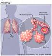 Asthmatic Lungs - This is a picture of what will happen with your lungs if you have asthma.