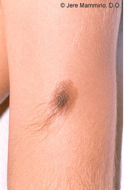 Moles in the skin - this is a sample of mole in the skin. do you have moles?