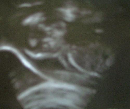 My baby at 20 weeks - That is my sono pic at 20 weeks..... he is adorable, ain't he?