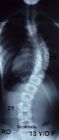 This isn't my back... - This is an x-ray of someone with Scoliosis