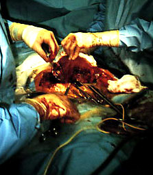 C-Section - This is what a womans stomach looks like right after the baby is removed by C-Section before repairing it.