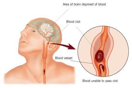 Stroke - This is a representation of what a stroke is.