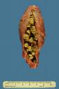Gallstones - This is a photo of gallstones, though they are not mine. 