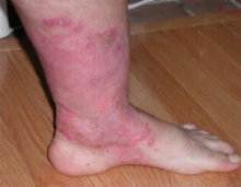 foot psoriasis - foot psoriasis is a particularly challenging form of disease. Difficult to endure and to treat.