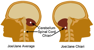 Chiari Malformation - This picture shows what Chiari is.