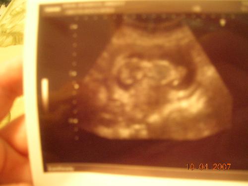 my baby - ultrasound pic