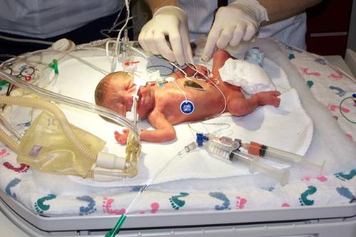 Premature Baby - My daughter who was born 12 weeks early at 2 lbs 1 1/2 ozs.
