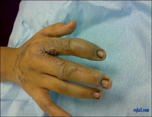 explosion of mobiles - this is also the continuation of the same...but this one shows the hazard caused to human life...that guy got his hands burned off due to mobile explosion