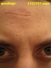 scar - I do have a scar on my forehead that reminds me of my late father who is no more now. Which always reminds me of an incident.