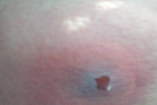 This is what the Brown Recluse Bite looked like Pr - This is the shot of the bite prior to having surgery. After applying moisture and heat and letting it mature all day approximately 16 hrs the redness has came to a head its not spread out so much but the blackness came from the heat and moisture which during surgery is what had to be cut out to relieve me of the pressure and pain that i was getting up and down my leg. This is what the Brown Recluse Bite looked like Pr - This is the shot of the bite prior to having surgery. After applying moisture and heat and letting it mature all day approximately 16 hrs the redness has came to a head its not spread out so much but the blackness came from the heat and moisture which during surgery is what had to be cut out to relieve me of the pressure and pain that i was getting up and down my leg.