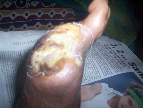 Gangrene - Shows a snap of the amputed Bit toe. Gangrene - Shows a snap of the amputed Bit toe.