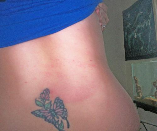 My Back - Heres my back after I fell down my stairs