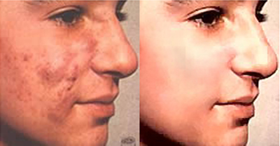 Pimples  - Pimples before and after