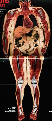 Oh... fat. - Here is an MRI scan showing how much fat is in a person&#039;s body.