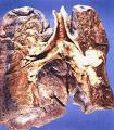 quit - might be your lung if u continue...