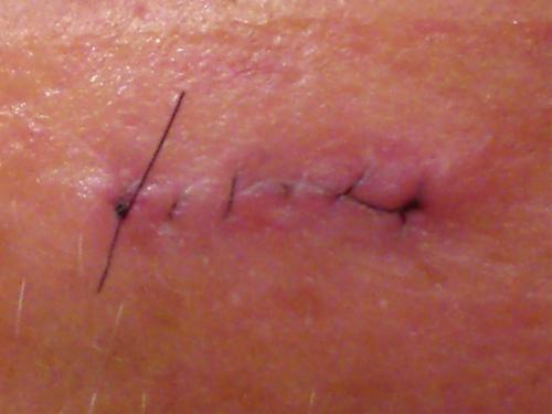 Sutures - You must be bold.