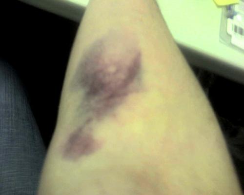 Bruise from Getting an Injection - I received this bruise when I had an MRI yesterday. The nurse was pressing the needle down to keep it in veins because I have steroid veins and that is the only way he could give me the injections Bruise from Getting an Injection - I received this bruise when I had an MRI yesterday. The nurse was pressing the needle down to keep it in veins because I have steroid veins and that is the only way he could give me the injections