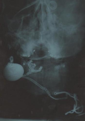 paranormal - My medal worn around my neck, the chain also silver from a stretcher emergency room admittance x-ray shows engraved star . .