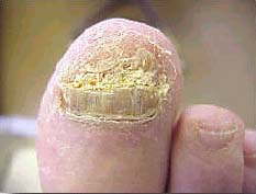 Funal Nails are common - Here you can see that the toe has onychomycosis and it is treatable. Common too! Visit diagnosethat.com to see what you can take for that.
